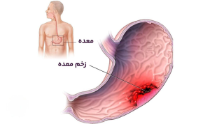 درمان زخم معده در مکتب دکتر خیراندیش
