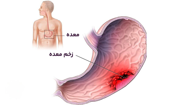 درمان زخم معده در مکتب دکتر خیراندیش